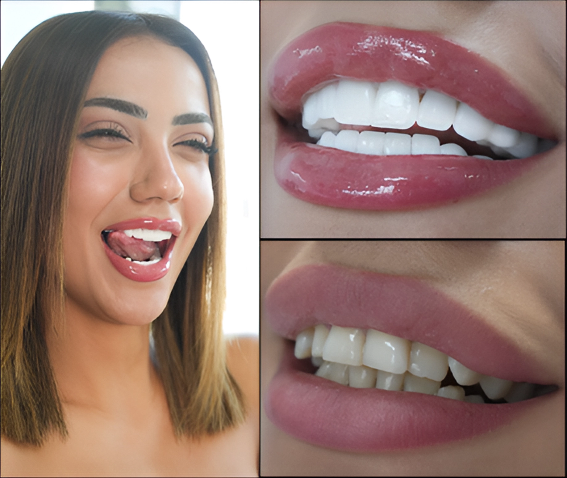 Vorher Nachher von Hollywood Smile