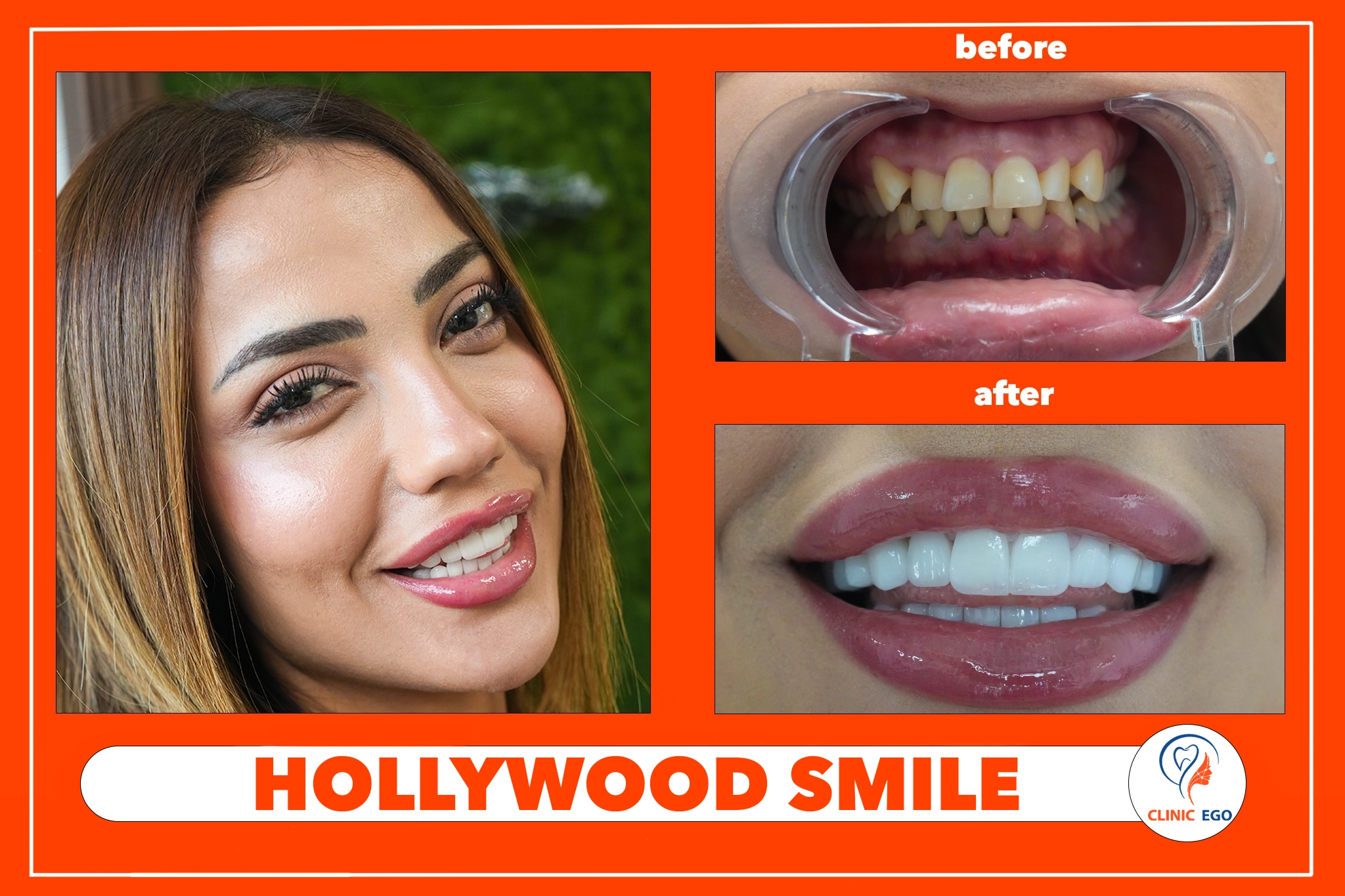 Hollywood Smile